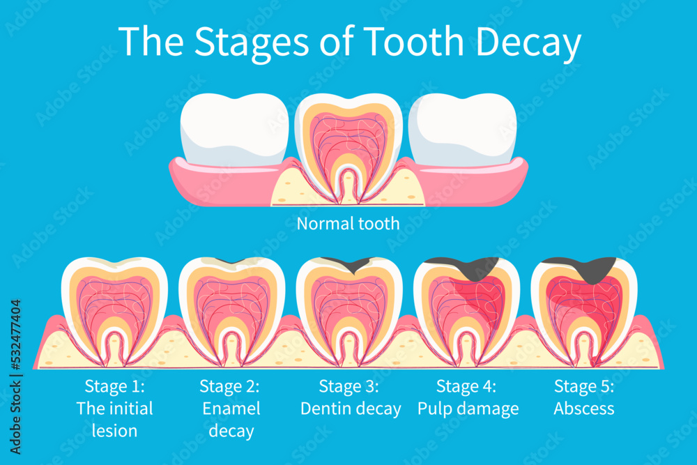 Stages development of tooth decay, dental plaque in enamel and dentin