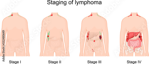 lymphoma stage. Cancer of the lymphatic system.
