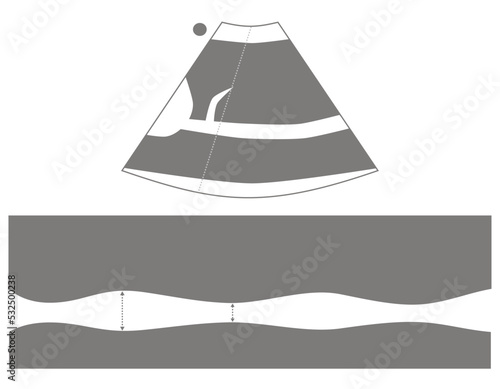 Diagram of Inferior Vena Cava Ultrasound in M Mode