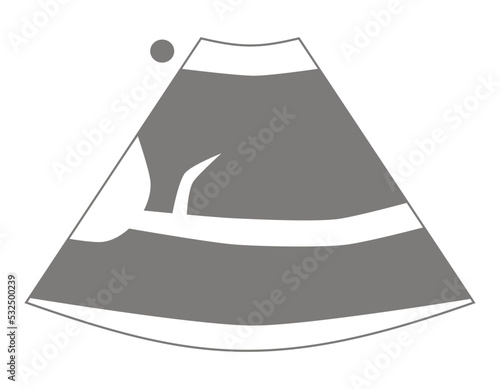 Diagram of Inferior Vena Cava Ultrasound
