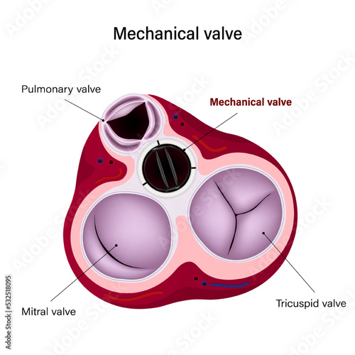 Mechanical valve. Aortic valve replacement. Heart anatomy vector. Heart valve repair.