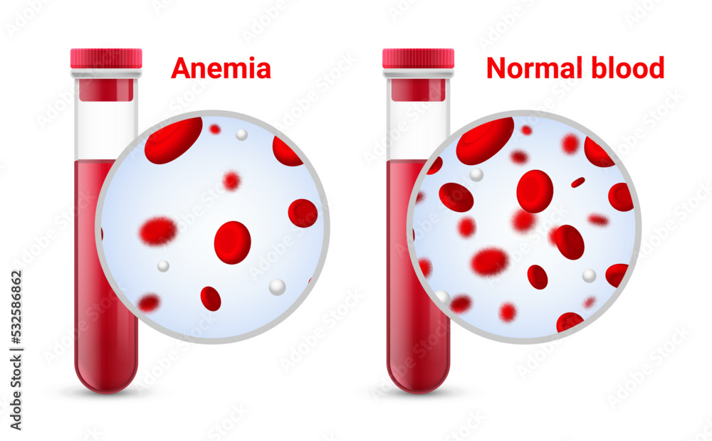 Anemia problem circulatory iron body diagram background. Anaemia