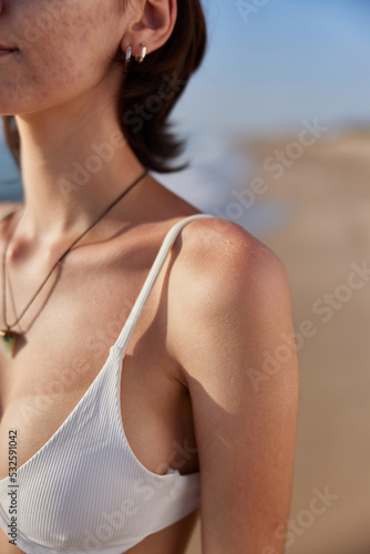Brunette woman with sunburned skin