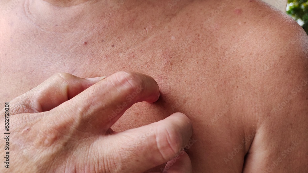 Portrait showing Inflammatory acne on the body, blemish and freckles, rough skin and dark spots, problem scratching rash, hives on the body of the male patient, concept health care. Portrait showing Inflammatory acne on the body, blemish and freckles, rough skin and dark spots, problem scratching rash, hives on the body of the male patient, concept health care.
