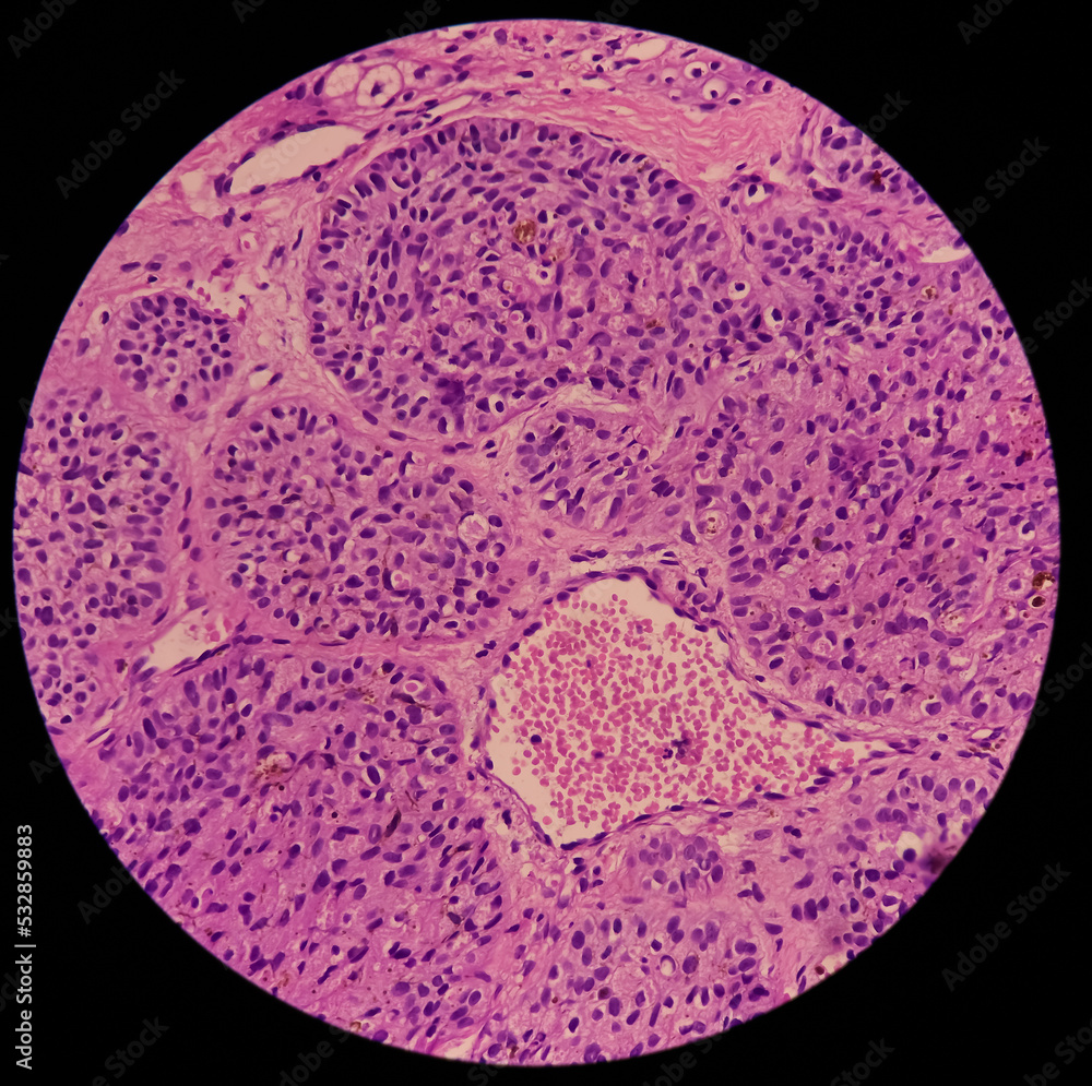 Punch Biopsy of face skin: face skin carcinoma, pigmented basal cell carcinoma, the most common type of sun induced skin cancer. Punch Biopsy of face skin: face skin carcinoma, pigmented basal cell carcinoma, the most common type of sun induced skin cancer.