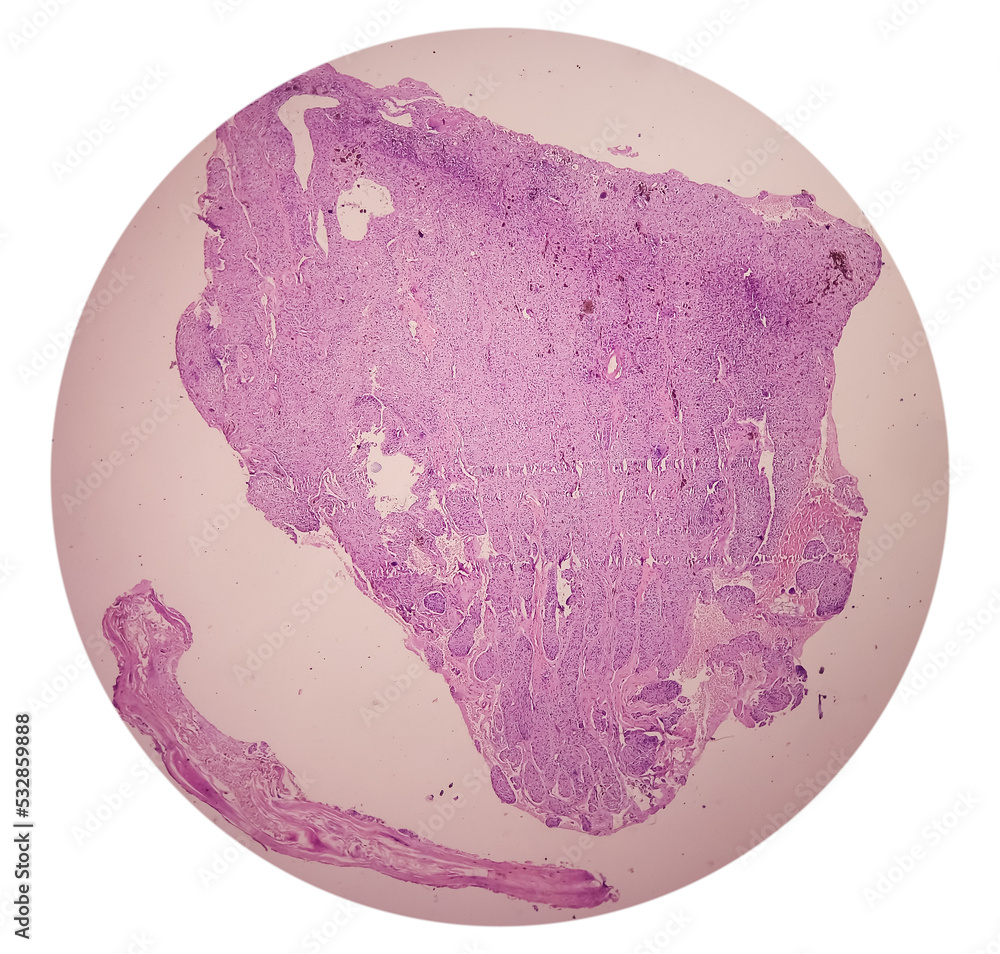 Punch Biopsy of face skin: face skin carcinoma, pigmented basal cell