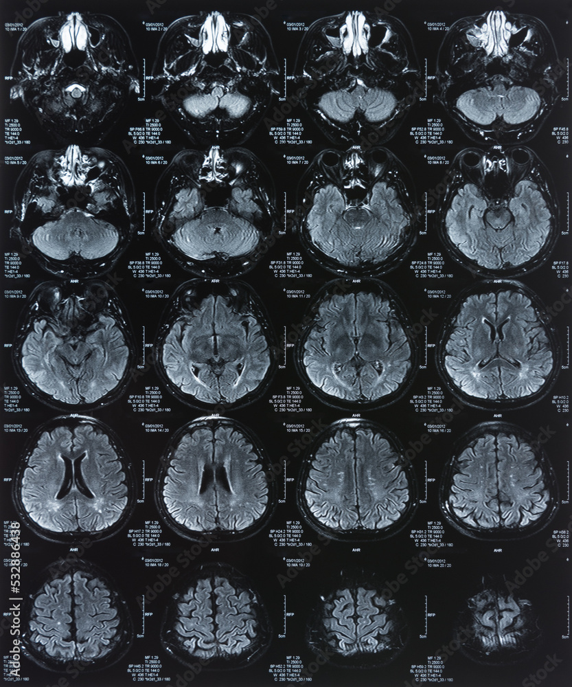 x-ray film image of brain by mri, ct scan for medical diagnosis. Stock