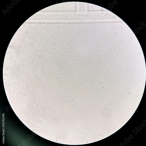 Fresh spermatozoa in urine sediment. photo