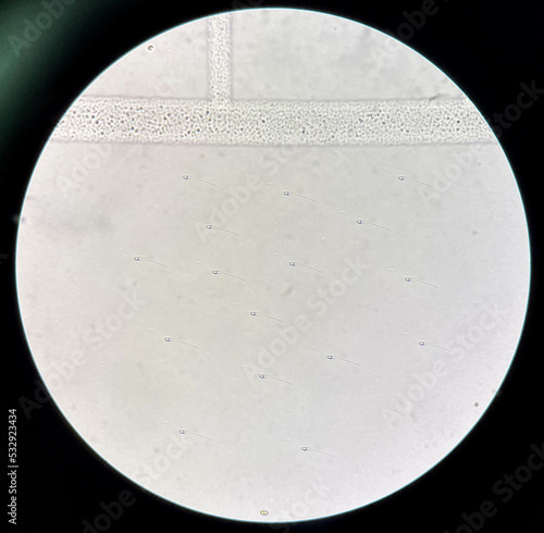 Fresh spermatozoa in urine sediment. photo