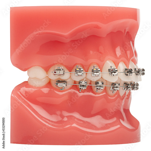 Orthodontic model demonstration teeth model of orthodontic bracket or brace. Metal braces on teeth on an artificial jaws closeup. Side view photo