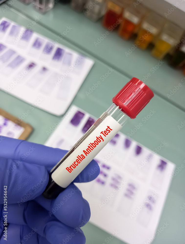 Blood sample for Brucella antibody test to diagnosis of brucellosis.