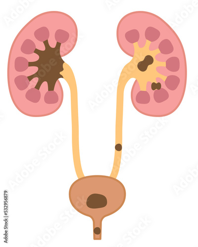 Urinary stone anatomy diagram illustration