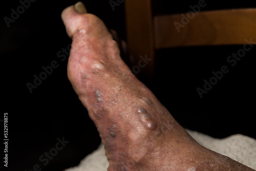 Caucasian man with thrombosed varicose veins on the back of his right foot.