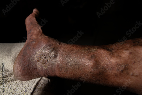 Caucasian man with thrombosed varicose veins on the back of his right foot.