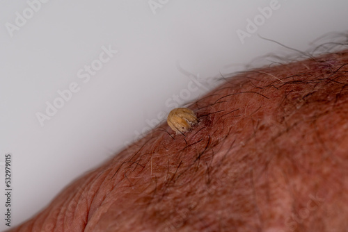 Hand of a 75-year-old Caucasian man with wart or cutaneous horn, which is an outgrowth of compact keratin.