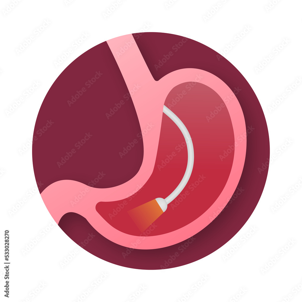 Stomach endoscopy. Endoscope in stomach through esophagus. stock