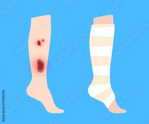 Leg bandage wrapping