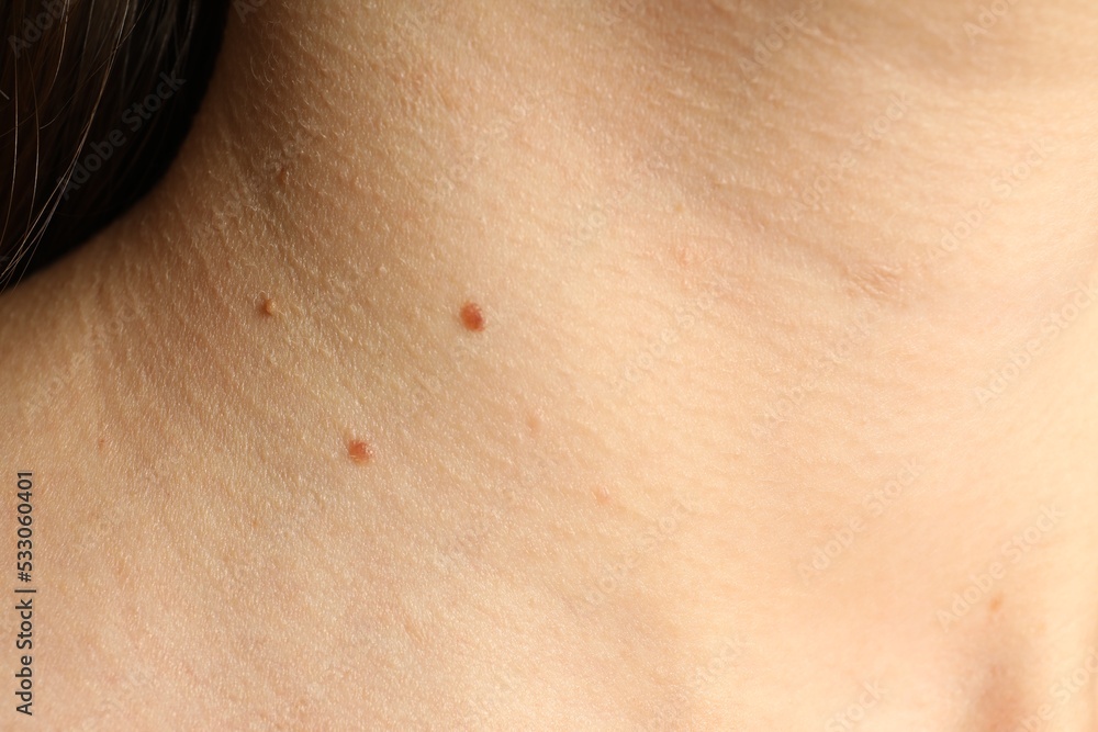 Fototapeta premium Closeup view of woman's body with birthmarks