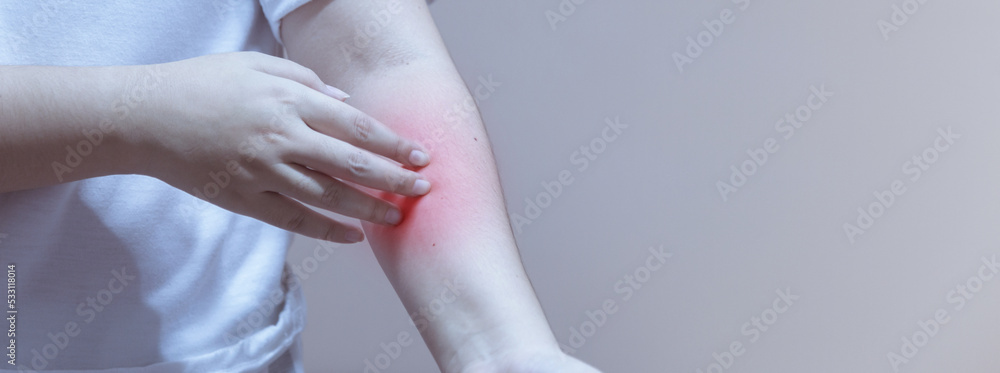 woman scratching arm from having itching allergic reaction to insect bites, dermatitis, food, drugs. Health care concept. woman scratching arm from having itching allergic reaction to insect bites, dermatitis, food, drugs. Health care concept.