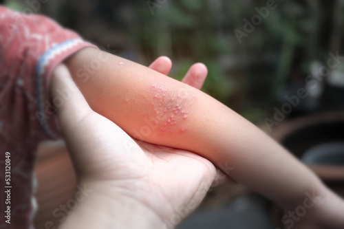 Hand foot and mouth disease is a mild. Hand-foot-and-mouth disease is most commonly caused by a coxsackievirus and Enterovirus. photo