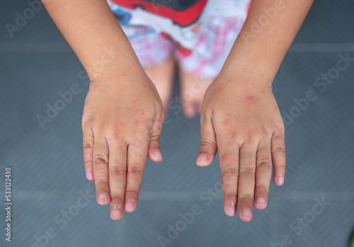 Rash on the hands of the Hand foot and mouth disease. Hand-foot-and-mouth disease is most commonly caused by a coxsackievirus and Enterovirus. photo