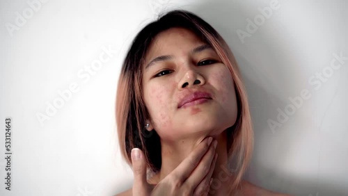 Asian Girl with Allergy skin is scratching on red spot with her hand for skin disease.