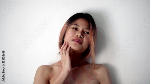 Asian Girl with Allergy skin is scratching on red spot with her hand for skin disease.