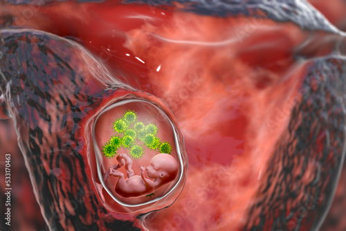 Fotografiet Transplacental transmission of Cytomegalovirus to human embryo