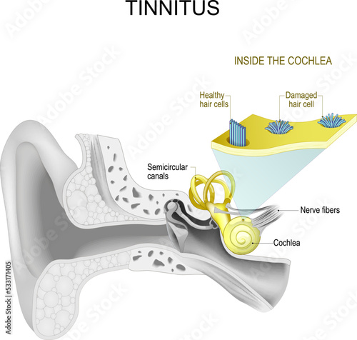 Tinnitus. Human ear.