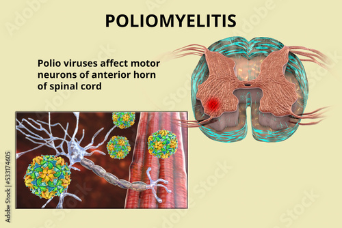Polio viruses affecting motor neurons photo
