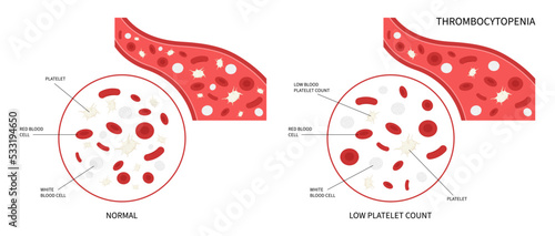 Decreased platelet count of enlarged spleen disorder complete low reddish purple spots hepatitis C alcoholism Alcohol use AIDS HIV virus nosebleed hematuria bruises red blood cell photo