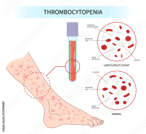 hepatitis virus disorder complete low platelet count reddish purple spots C enlarged spleen alcoholism Alcohol use AIDS and HIV decreased nosebleed hematuria bruises red blood cell photo