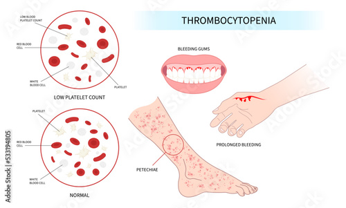 hematuria low platelet count disorder Decreased complete reddish purple spots hepatitis C enlarged spleen alcoholism Alcohol use AIDS HIV virus nosebleed bruises red blood cell photo