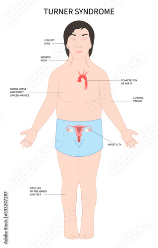 Turner and fragile syndrome of the X chromosomal abnormality test genetic with gonadal dysgenesis disorder in female