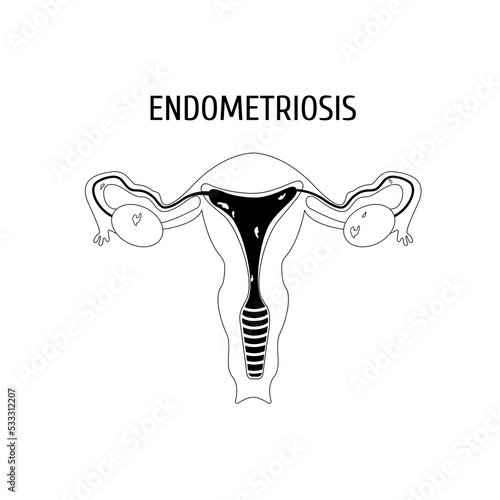 Endometriosis. Female genitals outline