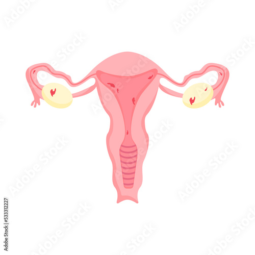 Female genitals. Endometriosis, vector illustration
