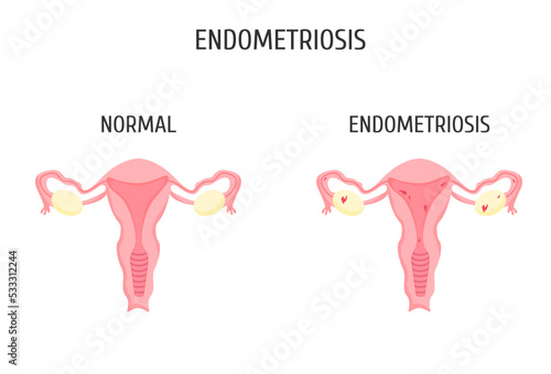 Female genital organs with and without endometriosis. Infographics.