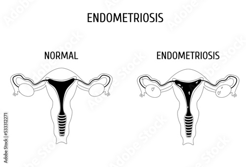 Female genital organs with and without endometriosis outline. Infographics.