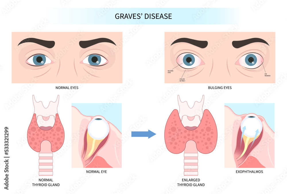 Hashimoto's thyroiditis and Graves' disease eye swollen tumor cancer