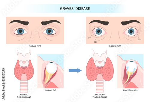 Hashimoto's thyroiditis and Graves' disease eye swollen tumor cancer therapy lump enlargement photo