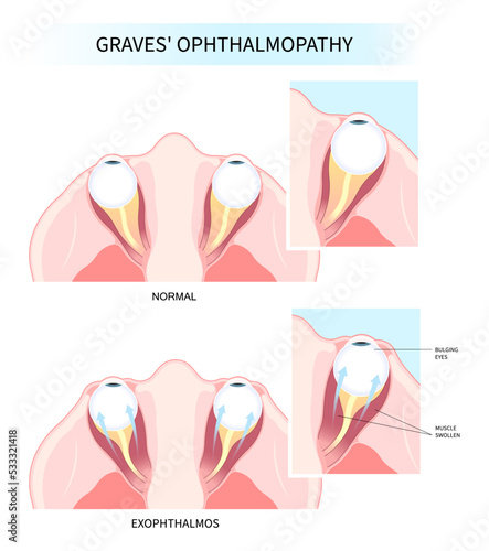 enlargement of the eye with Hashimoto's thyroiditis and Graves' disease swollen tumor cancer therapy lump photo