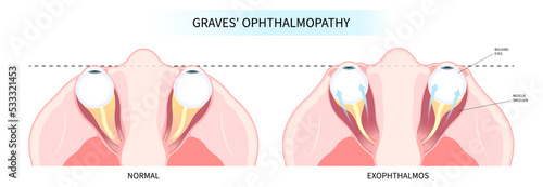 eye swollen with Hashimoto's thyroiditis and Graves' disease tumor cancer therapy lump enlargement photo