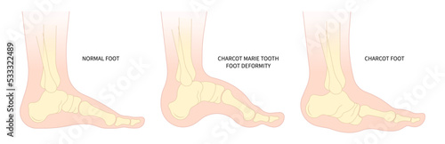 The Charcot foot anatomy painful and diabetic gout disease sores leg and Pes Cavus arches of Cavovarus hammer toes