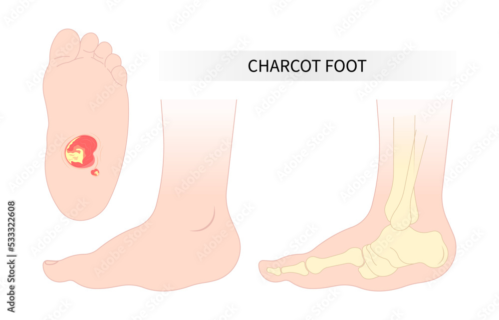 diabetic foot anatomy Bone fracture of the Charcot painful and gout