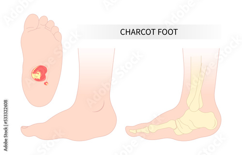 diabetic foot anatomy Bone fracture of the Charcot painful and gout disease sores leg and Pes Cavus arches with Cavovarus hammer toes