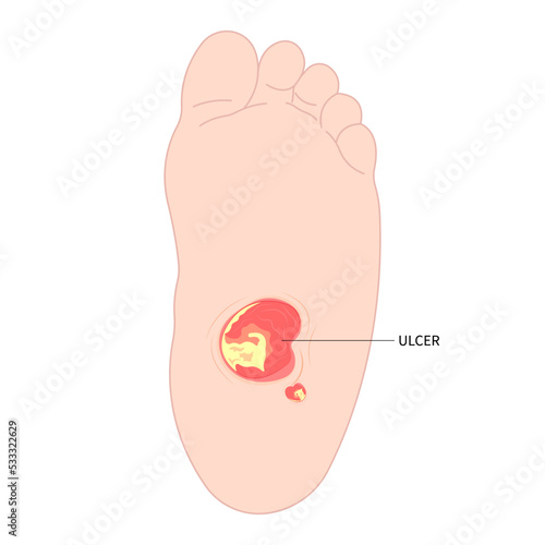 Diabetic foot with Charcot painful gout disease sores leg and Pes Cavus arches of Cavovarus hammer toes