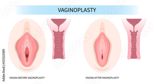 Surgery Female women vagina reconstruction of minor Vulval labia loose lips genital beauty tighten Hood Dry pain menopause disease and posterior colporrhaphy male by the Vulvoplasty Dyspareunia