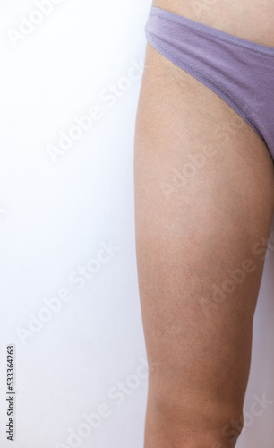 venous mesh on the legs of a young woman, a leg with an uneven tan
