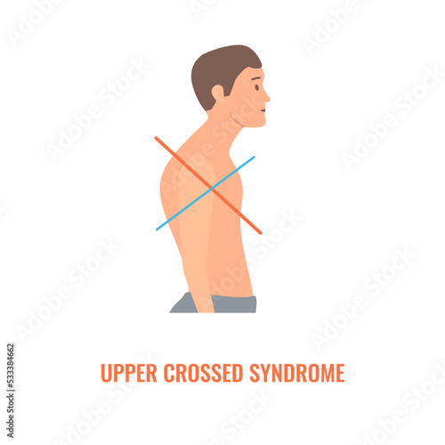 Upper crossed syndrome medical diagram. Crooked man with muscle strength imbalance. Weak and overactive muscles therapy. Incorrect spine curvature caused by bad posture. Vector illustration.