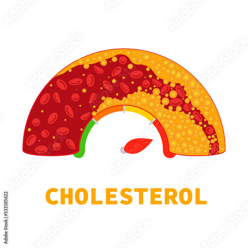 Cholesterol level on blocked blood vessel medical diagram. Meter gauge of bad hdl lipoprotein. High and low fat test indicator. Atherosclerosis risk. Healthcare concept. Vector illustration.